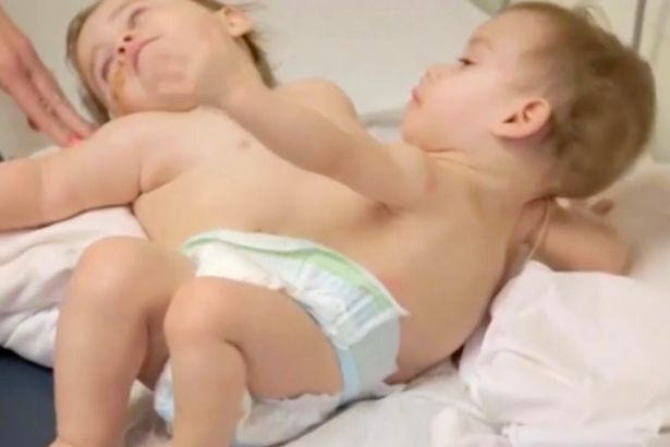 conjoined-twins-who-faced-each-other-separated-in-california-surgery