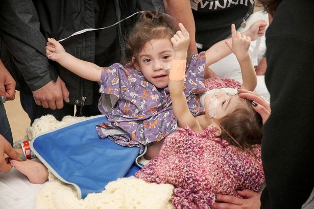 handout-photo-of-erika-and-eva-sandoval-before-their-separation-surgery-in-palo-alto-california