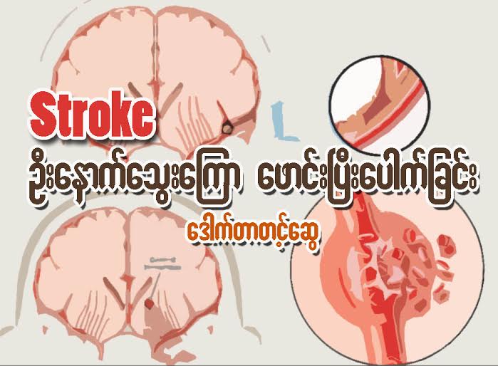 Stroke ဦးေႏွာက္ေသြးေၾကာ ေဖာင္းၿပီးေပါက္ျခင္း