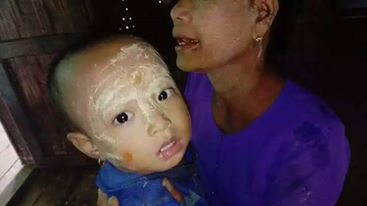 မင္းျပားၿမိဳ႕နယ္တြင္ ေရႀကီးၿပီးေနာက္ လူ ၁၀၀ ေက်ာ္ အေရျပားႏွင့္ ၀မ္းပ်က္၀မ္းေလွ်ာျဖစ္ပြား