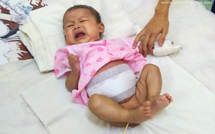 ၃ လသားကေလးဗိုက္ထဲရွိ သံုးႁမႊာပူး သေႏၶသားမ်ားကို ေနျပည္ေတာ္တြင္ ခြဲစိတ္ကုသ