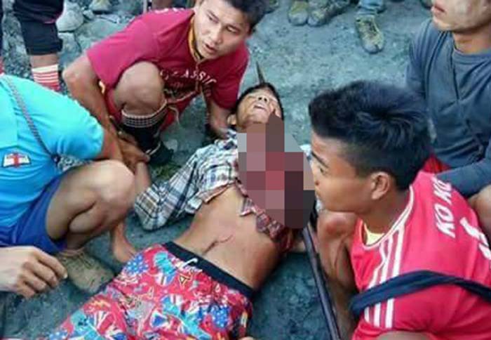 ဦးေခါင္းသံခၽြန္စိုက္၀င္ခဲ့သည့္ ဖားကန္႔ေရမေဆးသမား ခြဲစိတ္မႈေအာင္ျမင္