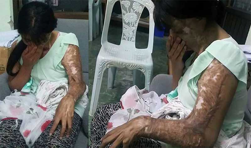 အိမ္အကူအမ်ဳိးသမီးအား အက္ဆစ္ျဖင့္ပက္သည့္ အိမ္ရွင္ ၂ ဦးကုိ အမႈဖြင့္