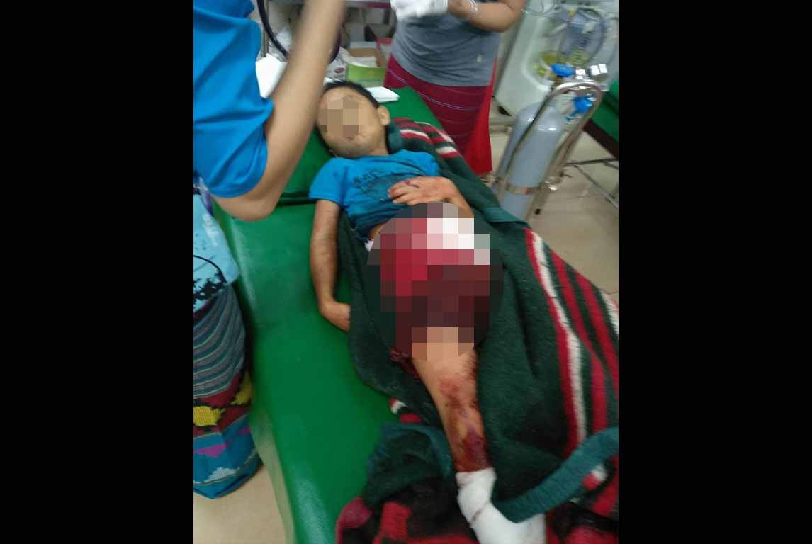 နမၼတူတြင္ ရြာထဲလက္နက္ႀကီးက်ည္ ေပါက္ကြဲ၍ ကေလး ၁ ဦးေသဆံုး၊ ၂ ဦး ဒဏ္ရာရ