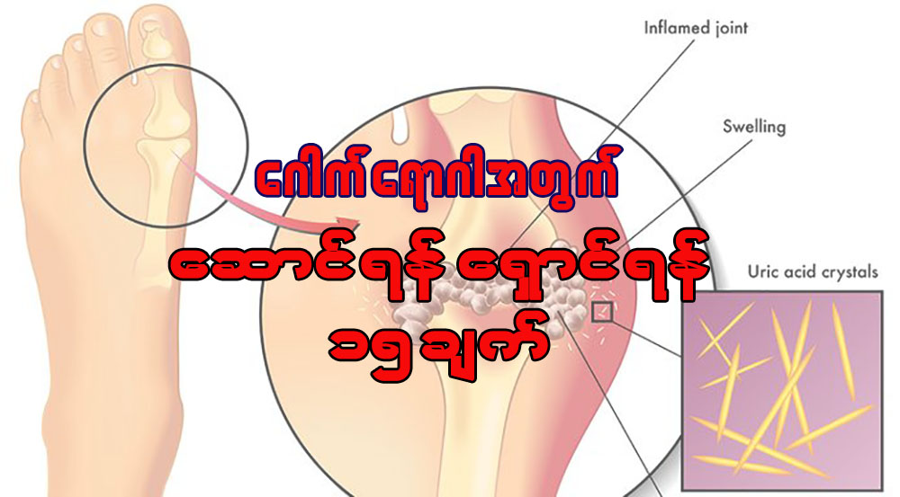 ေဂါက္ေရာဂါအတြက္ ေဆာင္ရန္ ေရွာင္ရန္ ၁၅ ခ်က္
