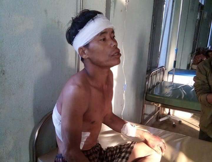နာဂေဒသတြင္ ေတာဝက္ပက္ခံရသျဖင့္ ရြာသား ၂ ဦး ျပင္းထန္စြာဒဏ္ရာရ