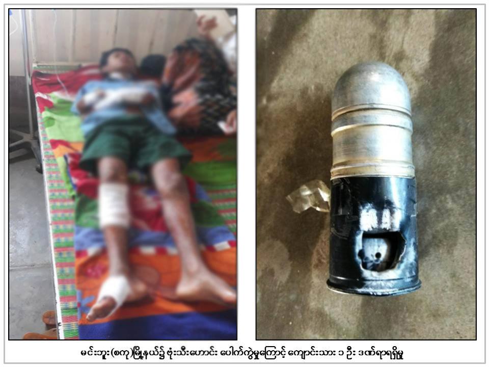 မင္းဘူး(စကု)ၿမိဳ႕နယ္တြင္ ဗုံးသီးေဟာင္းေပါက္ကြဲ၍ ေက်ာင္းသား ၁ ဦး ဒဏ္ရ