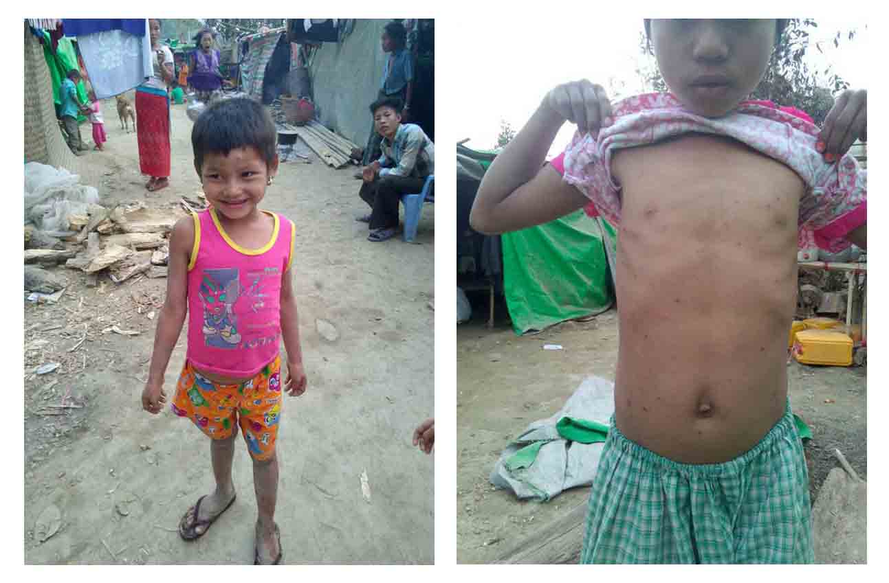 ဝါး​ေတာင္​ စစ္​​ေဘး​ေ႐ွာင္​စခန္​းတြင္​ ဝမ္​း​ေရာဂါ ႏွင့္ ​​ေရ​ေက်ာက္​ေရာဂါ​ ​ကူးစက္​မႈျဖစ္​ပြား​ေန