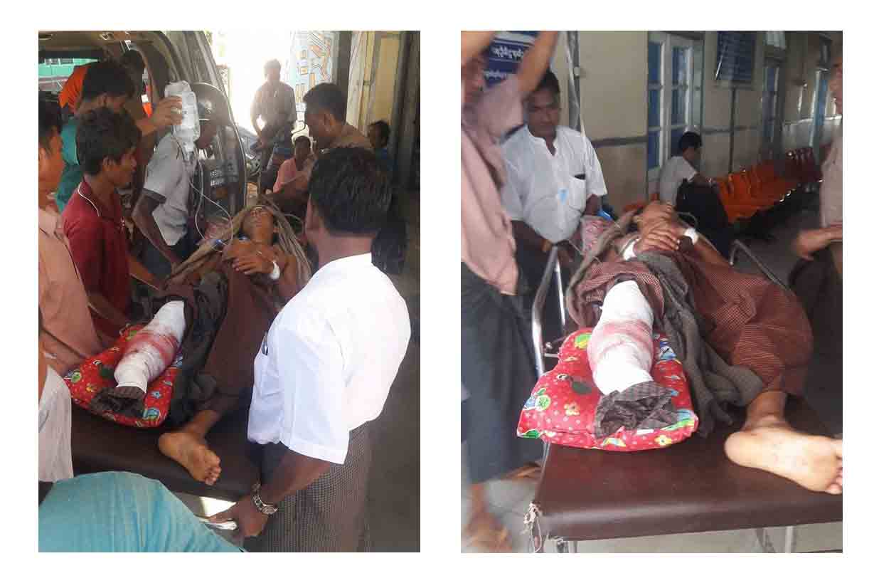 ပုဏၰားကၽြန္းတြင္ တညင္းခင္းသြားသည့္ အရပ္သားတဦး မိုင္းနင္းမိ၊ ဒဏ္ရာျပင္းထန္