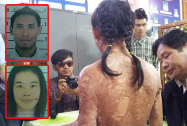 ကရင္မိန္းကေလးငယ္တဦးကုိ ထိုင္းအလုပ္႐ွင္က ေရေနြးပူေလာင္းနွိပ္စက္