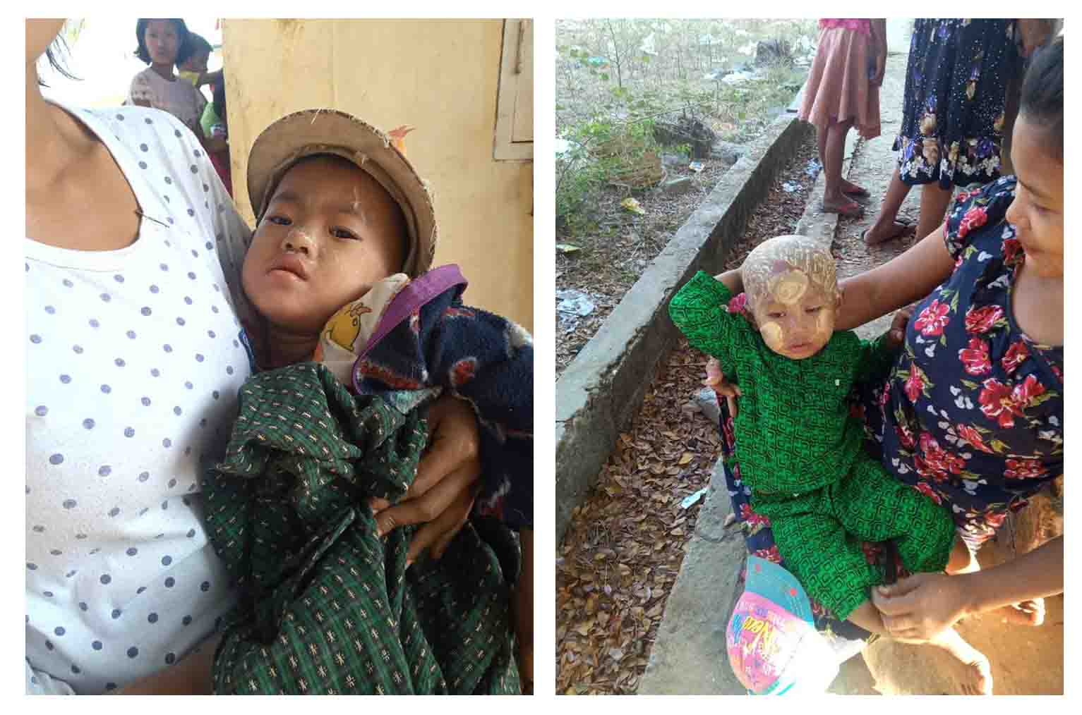 အမ်းမြို့နယ်တွင် ကလေးငယ်များ ဝက်သက်(သံသယ) ရောဂါဖြစ်ပွား ၁ ဦး သေဆုံး