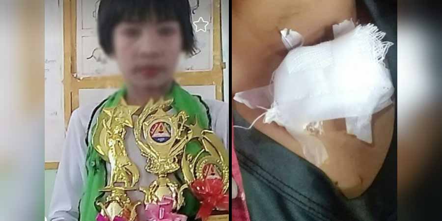 ခင်ဦးမြို့နယ်တွင် ထွေအုပ်ဝန်ထမ်းက ကလေးငယ်ကို သွေးထွက်သံယိုရိုက်၊ ရဲက အရေးမယူ