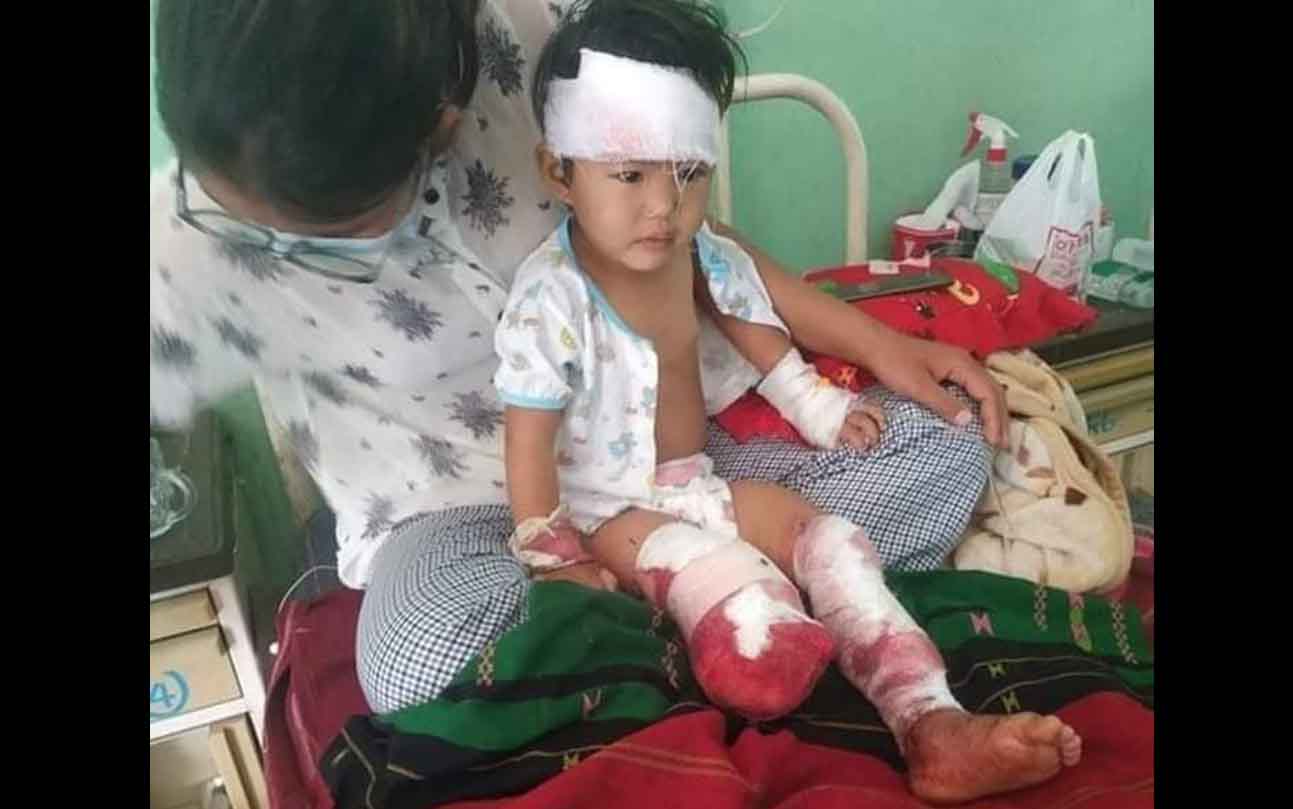 မင်းတပ်တွင် မြေမြှုပ်မိုင်းနင်းမိသဖြင့် မိခင်ဖြစ်သူသေဆုံးပြီး ၂ နှစ်သမီး ခြေတောက်ပြတ်