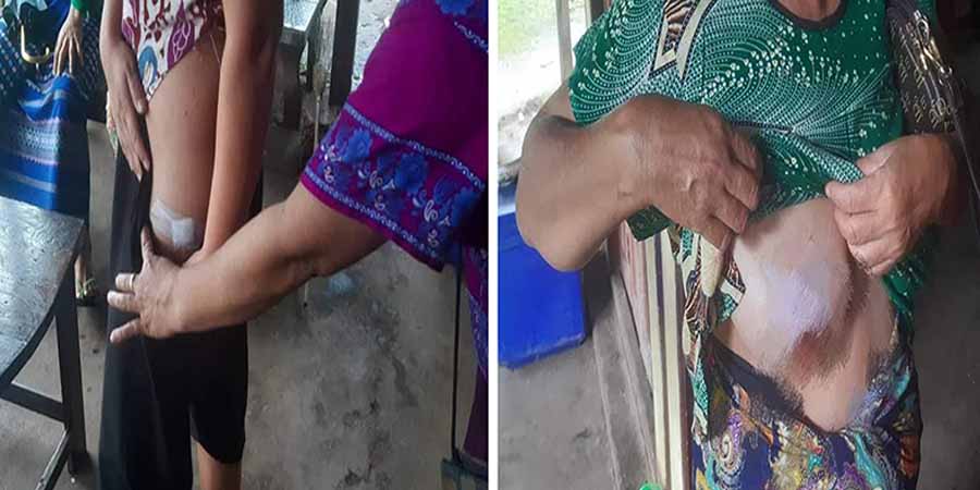 သထုံမြို့နယ်တွင် စစ်ကောင်စီတပ် ပစ်ခတ်မှုကြောင့် အမျိုးသမီး ၂ ဦး ဒဏ်ရာရ
