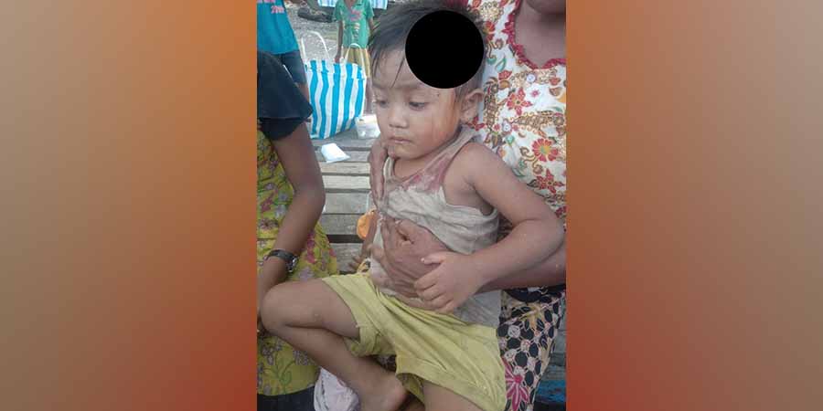 စစ်တပ်က လက်နက်ကြီးပစ်ခတ်မှုကြောင့် မြောက်ဦး မောင်းဆွဲရွာက ကလေး ၂ ဦး ဒဏ်ရာရ