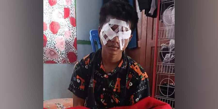 မိုင်းမတော်တဆဖြစ်ပြီး မျက်ကြည်လွှာခွဲစိတ်ရမည့် မြိုင် PDF ရဲဘော် အကူအညီ လိုအပ်နေ