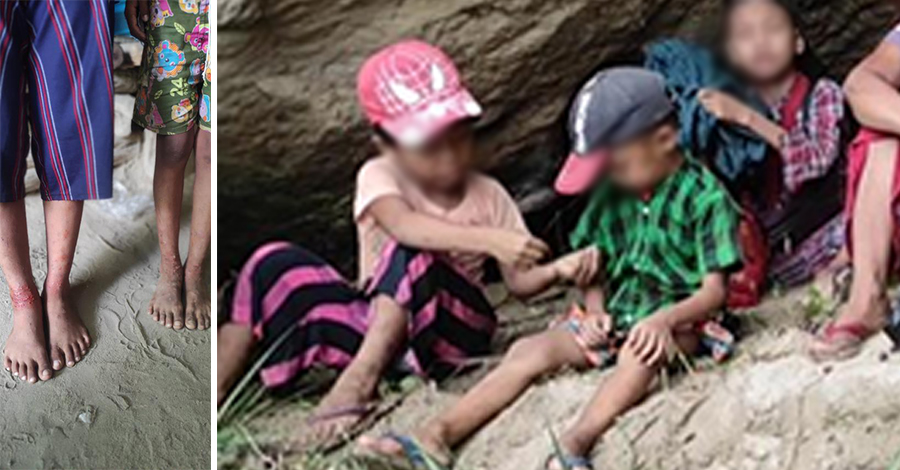 မင်းကင်း စစ်ဘေးရှောင်စခန်းရှိ ကလေးငယ်များ အနာစိမ်းပေါက်ပြီး ဆေးဝါးအကူအညီ လိုအပ်