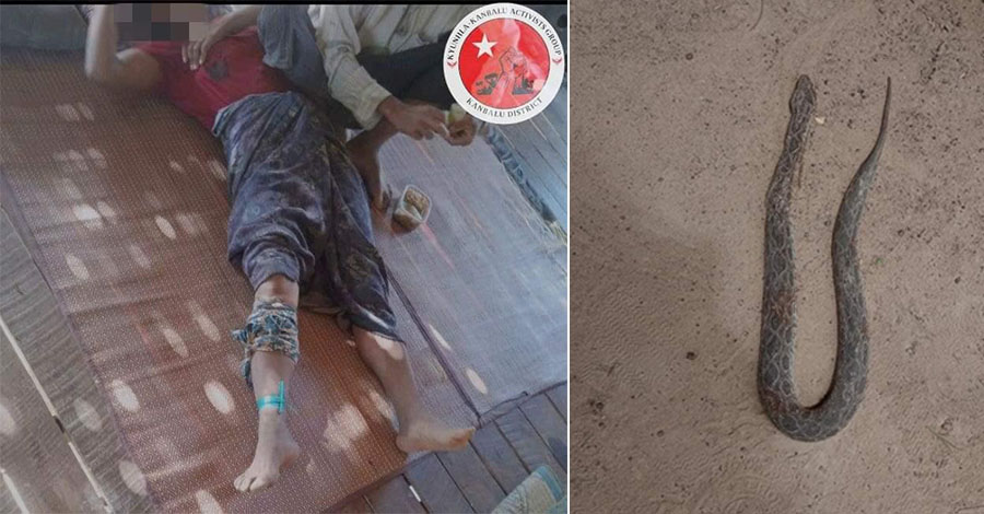 ကန့်ဘလူခရိုင်၌ ဩဂုတ်လအတွင်း ပြည်သူ ၁၁ ဦး မြွေကိုက်ခံရပြီး ၂ ဦး အသက်ဆုံးရှုံး