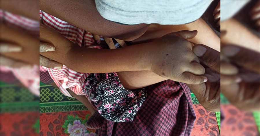 အဆိပ်ရှိအကောင် ကိုက်ခံရသည့်ကလေးငယ် ဆေးရုံပြောင်းရင်း သေဆုံး