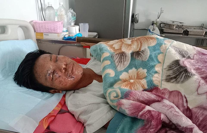 စေတုတ္တရာက မိုင်းထိတော်လှန်ရေးရဲဘော်အတွက် ဆေးကုသစရိတ်လိုအပ်နေ