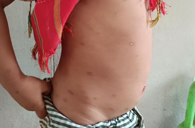 ဒီးမော့ဆိုတွင် ကလေးငယ် အယောက် ၄၀ ကျော် ရေကျောက်ရောဂါဖြစ်ပွား