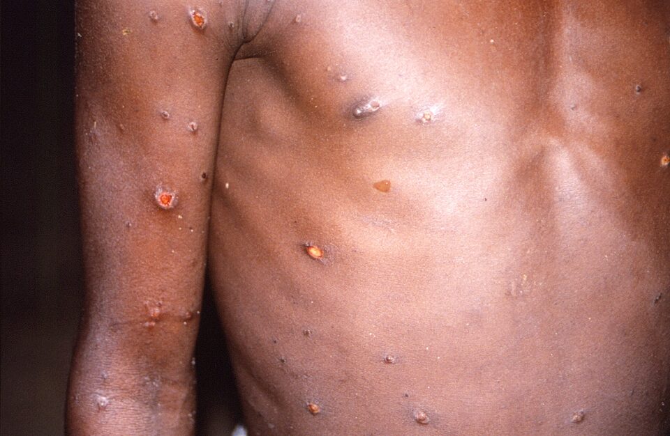 မြန်မာတွင် မျောက်ကျောက် (Mpox) ရောဂါ အတည်ပြုလူနာမရှိသေး