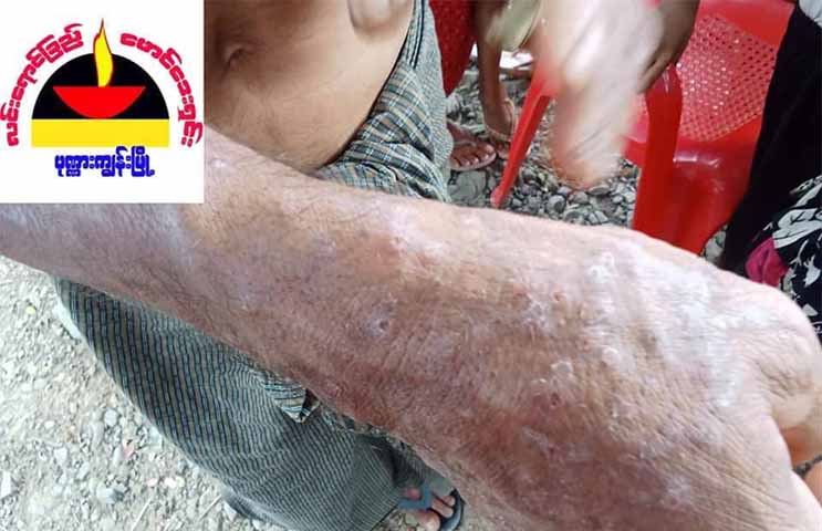 ပုဏ္ဏားကျွန်း စစ်ဘေးရှောင်များ အရေပြားရောဂါ ဖြစ်ပွားနေ