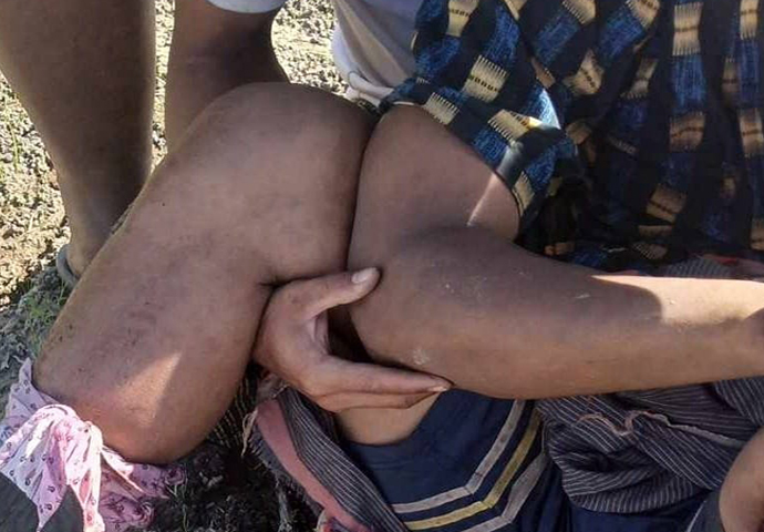 လက်ပံတန်းတွင် မြေမြှုပ်မိုင်းနင်းမိပြီး အမျိုးသား ၁ ဦး ခြေတဖက်ဆုံးရှုံး