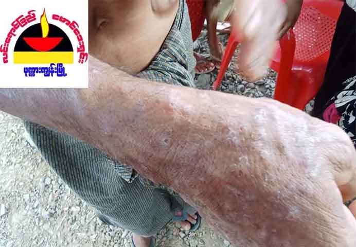 ရခိုင်ပြည်နယ်၌ အရေပြားရောဂါဖြစ်ပွားမှုနှင့်  သောက်သုံးရေ ရှားပါးမှုပြဿနာ ကြုံတွေ့နေရ