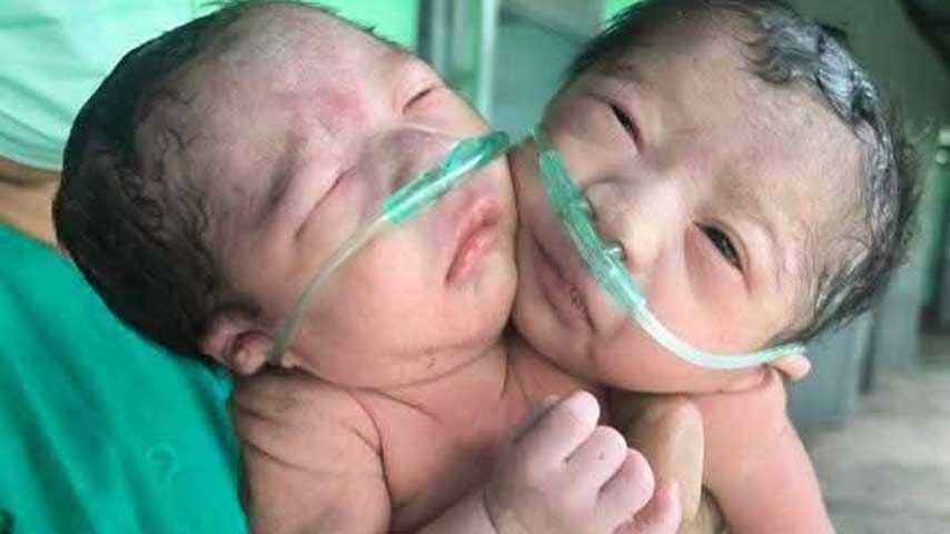 လပွတ္တာတွင် ဦးခေါင်း ၂ လုံးပါ ယောက်ျားလေး ၁ ဦး မွေးဖွား